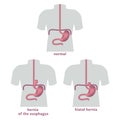 Torso with hernia of the stomach and esophagus.